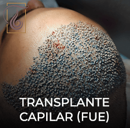 Transplante Capilar - imagem